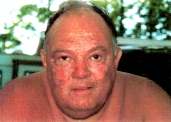 Photo of Harold 1 week after accident